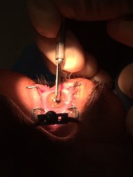 Close Up of Eye Surgery