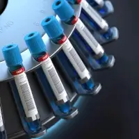 Autologous Serum Drops Save You from Dry Eyes